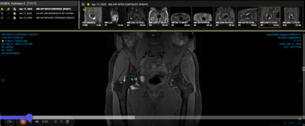 Kathleen Bober's hip MRI