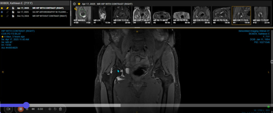 Kathleen Bober's hip MRI