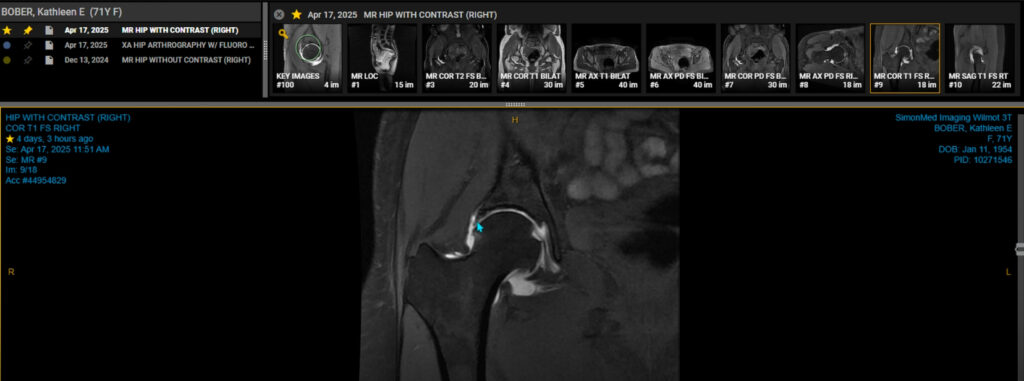 Kathleen Bober's Hip Arthrogram
